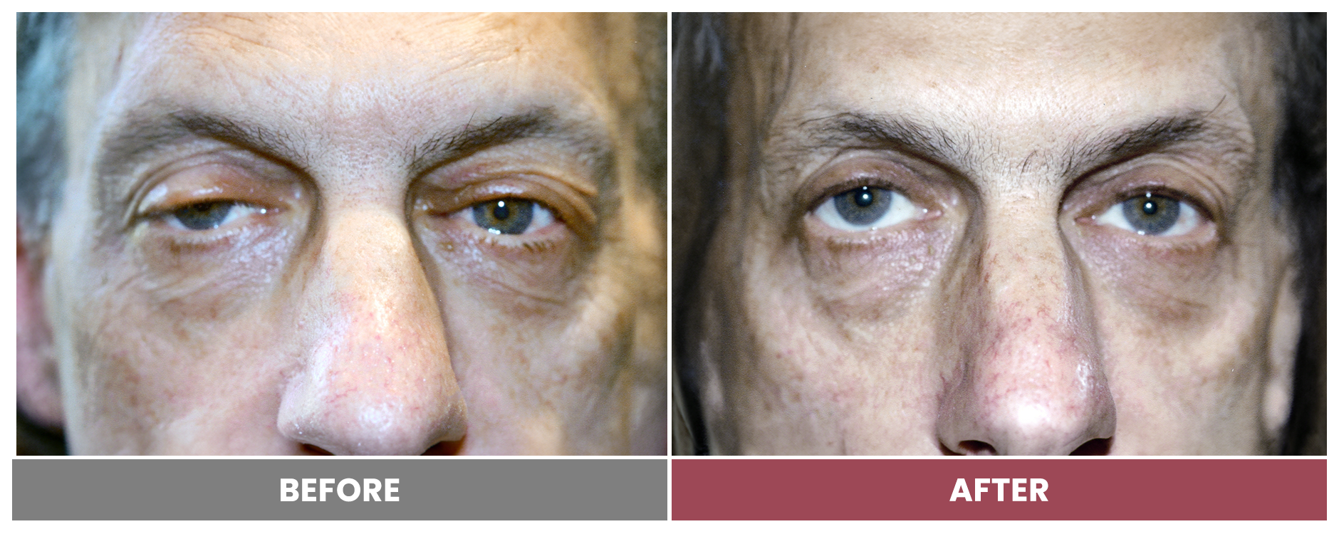 PTOSIS REPAIR - Case 55
